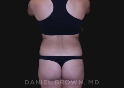 Liposuction Before & After Patient #10280