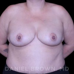 Bellesoma Breast Lift Before & After Patient #8366