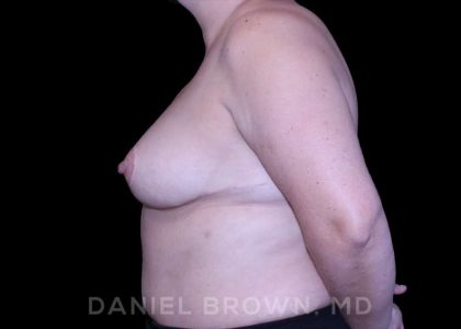 Bellesoma Breast Lift Before & After Patient #8366