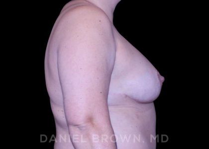 Bellesoma Breast Lift Before & After Patient #8366
