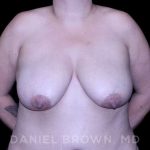 Bellesoma Breast Lift Before & After Patient #8366