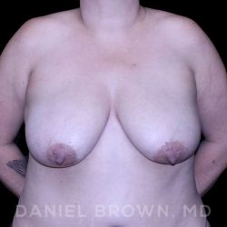 Bellesoma Breast Lift Before & After Patient #8366