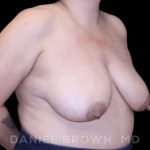 Bellesoma Breast Lift Before & After Patient #8366