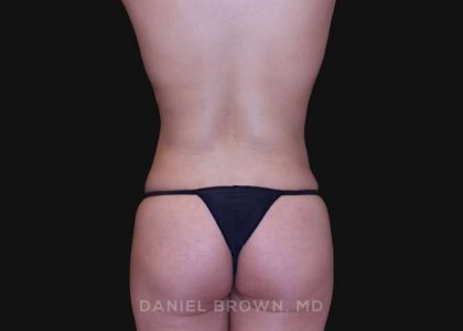 Liposuction Before & After Patient #10293