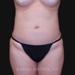 Liposuction Before & After Patient #10293