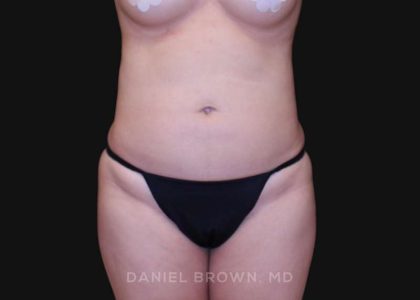 Liposuction Before & After Patient #10293