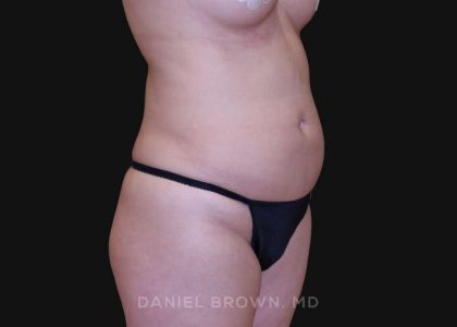 Liposuction Before & After Patient #10293
