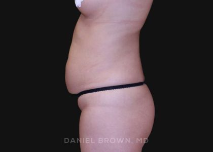 Liposuction Before & After Patient #10293