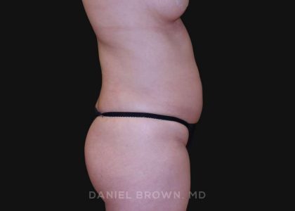 Liposuction Before & After Patient #10293