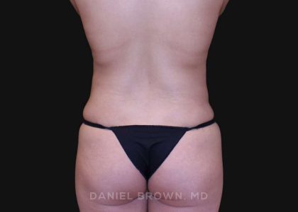 Liposuction Before & After Patient #10293