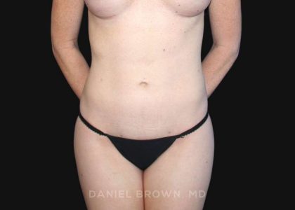 Liposuction Before & After Patient #10304