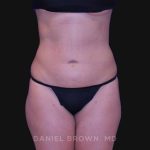 Liposuction Before & After Patient #10317