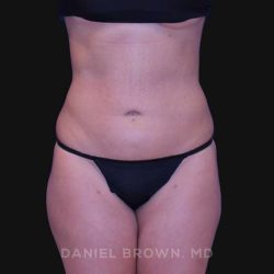 Liposuction Before & After Patient #10317