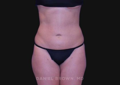 Liposuction Before & After Patient #10317