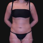 Liposuction Before & After Patient #10317