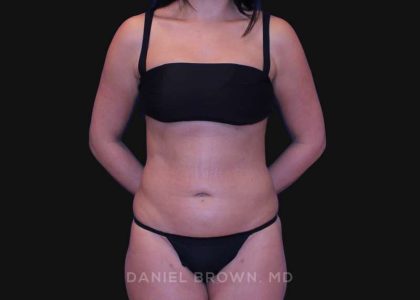 Liposuction Before & After Patient #10317