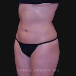 Liposuction Before & After Patient #10317