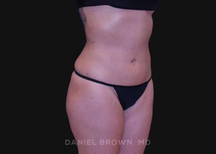 Liposuction Before & After Patient #10317