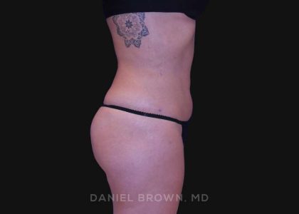 Liposuction Before & After Patient #10317