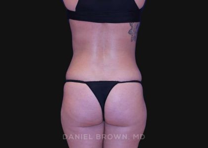 Liposuction Before & After Patient #10317