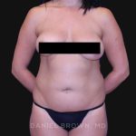 Liposuction Before & After Patient #10317
