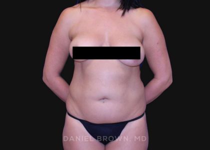Liposuction Before & After Patient #10317