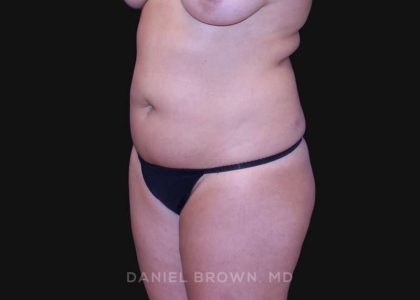 Liposuction Before & After Patient #10317