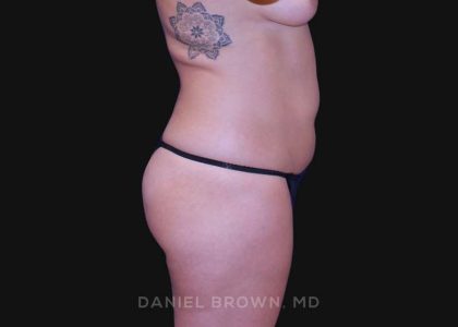 Liposuction Before & After Patient #10317