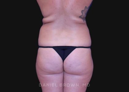 Liposuction Before & After Patient #10317