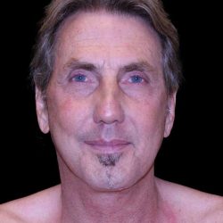 Facelift Before & After Patient #9825