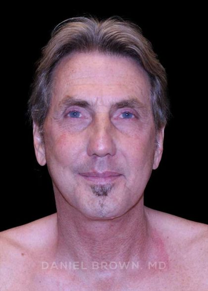 Facelift Before & After Patient #9825