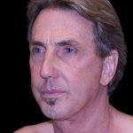 Facelift Before & After Patient #9825