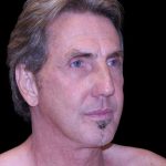 Facelift Before & After Patient #9825