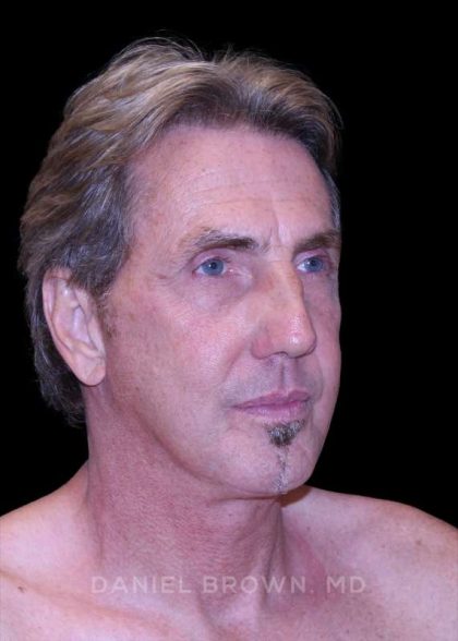 Facelift Before & After Patient #9825
