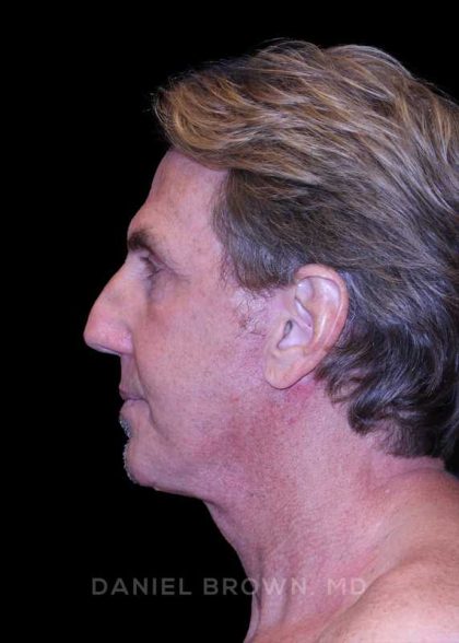 Facelift Before & After Patient #9825