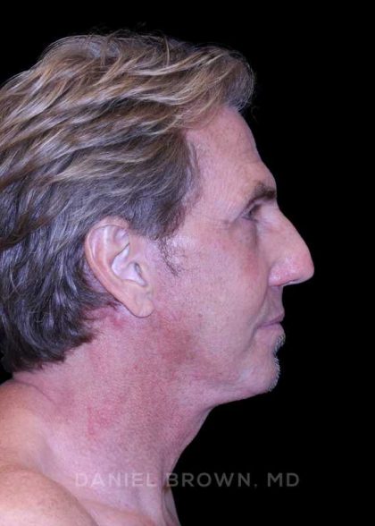 Facelift Before & After Patient #9825