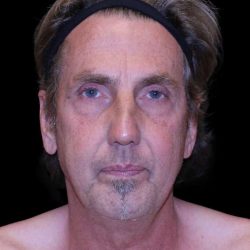 Facelift Before & After Patient #9825