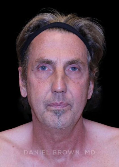 Facelift Before & After Patient #9825