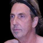 Facelift Before & After Patient #9825