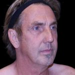 Facelift Before & After Patient #9825