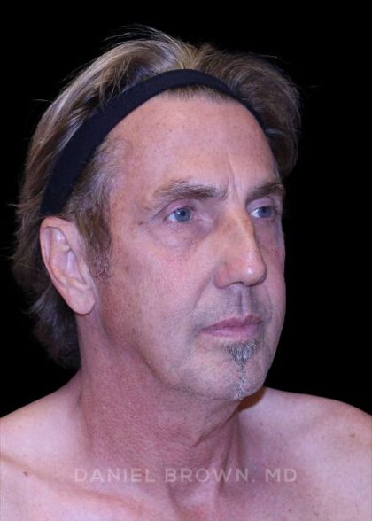 Facelift Before & After Patient #9825