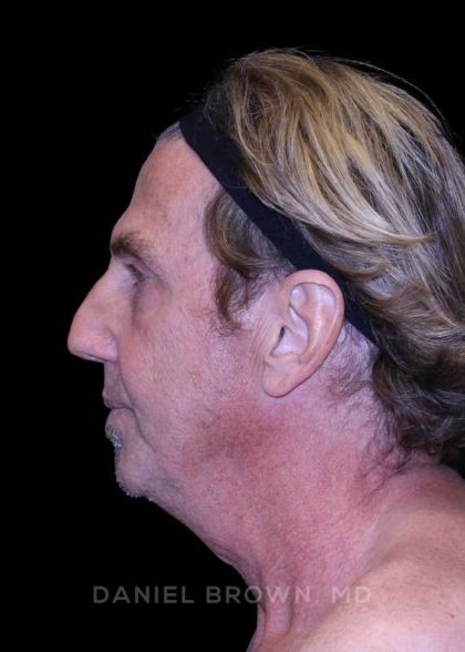 Facelift Before & After Patient #9825