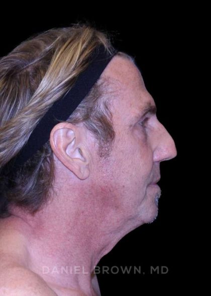 Facelift Before & After Patient #9825