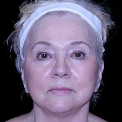 Facelift Before & After Patient #9836