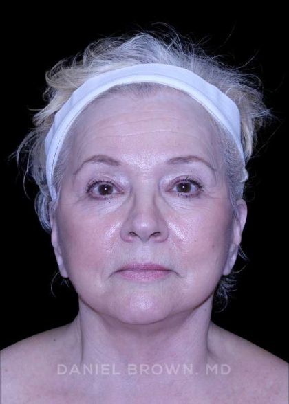 Facelift Before & After Patient #9836