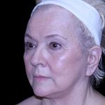 Facelift Before & After Patient #9836