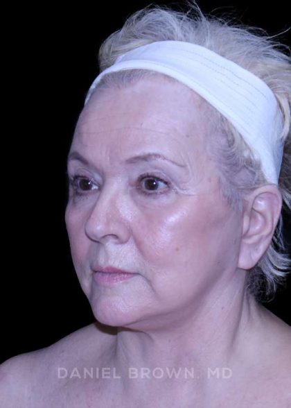 Facelift Before & After Patient #9836