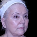 Facelift Before & After Patient #9836