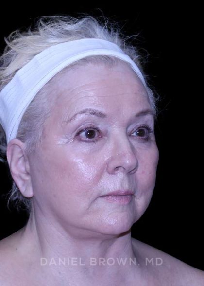 Facelift Before & After Patient #9836