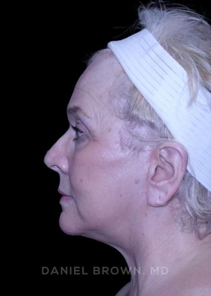 Facelift Before & After Patient #9836